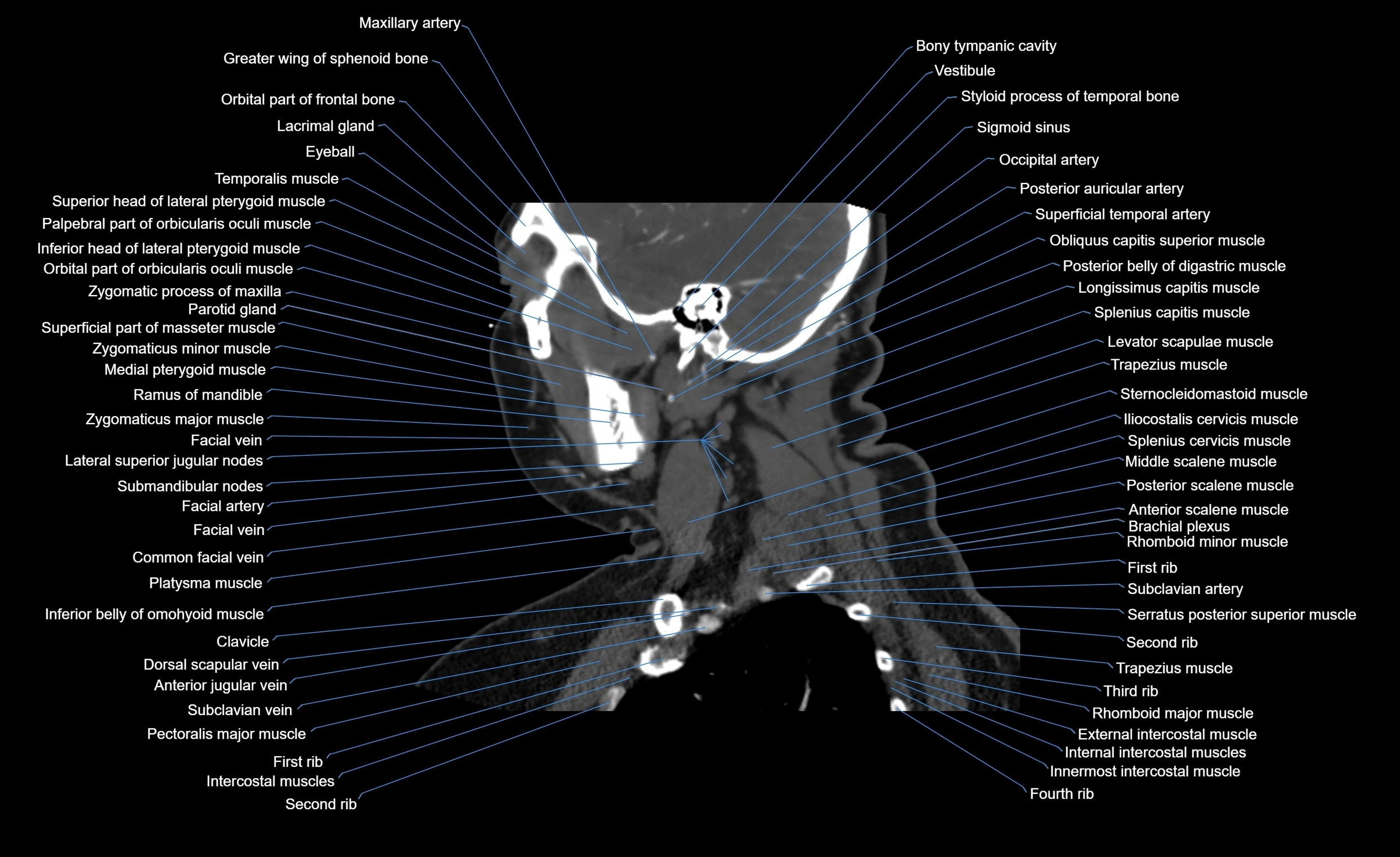 Neck CT sagittal cross sectional anatomy 3D  radiology  image-img-00001-00015.webp